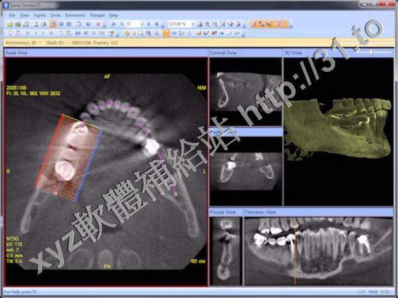Sante Dental CT v1.1.2 英文正式版(牙科CT多平面重建軟體)